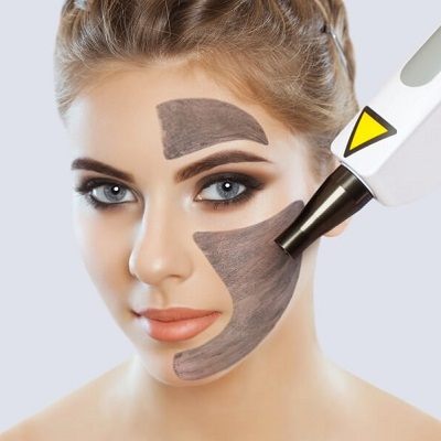 Laser Carbon Peel Facial in Dubai