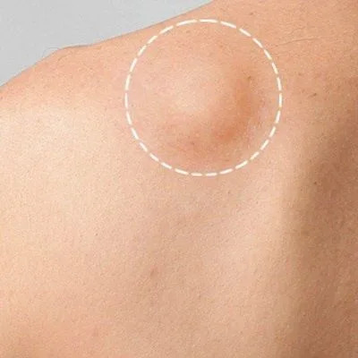 Lipoma treatment in Dubai