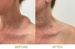 Lipoma treatment before & after