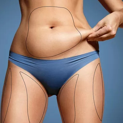 Liposuction Surgery in Dubai