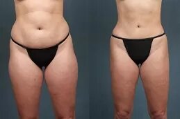 Liposuction dubai
