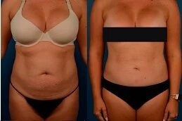 Liposuction before & Ater