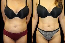 Liposuction before & Ater