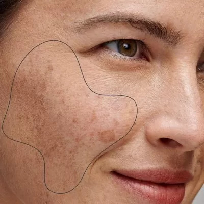 Melasma Treatment in Dubai