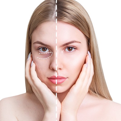 Under Eye Fillers in Dubai