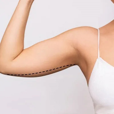 Arm Lift Surgery in Dubai