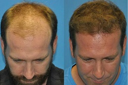 Best Hair Transplant Clinic in Dubai