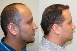 Best Hair Transplant in Dubai & Abu Dhabi