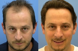 Best Hair Transplant in Dubai