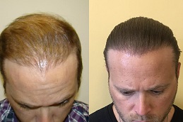 Best PRP Hair Treatment Dubai & Abu Dhabi