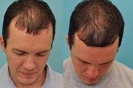 Best PRP Hair Treatment in Dubai