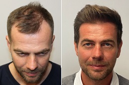 Hair Transplant Clinic in Dubai