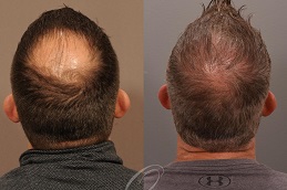 Hair Transplant in Dubai & Abu Dhabi