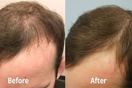 PRP Hair Treatment Clinic in Dubai