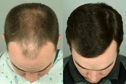 PRP Hair Treatment in Dubai & Abu Dhabi