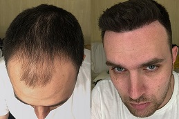 PRP Hair Treatment in Dubai, Sharjah