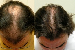 PRP Hair Treatment in Dubai