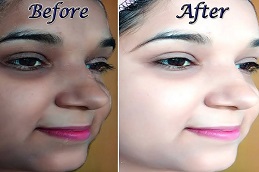Skin Whitening Treatment in Dubai & Abu Dhabi