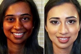 Skin Whitening Treatment in Dubai