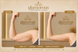 Arm Lift in Dubai & Abu Dhabi