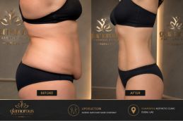 Before and After Liposuction treatment in Dubai