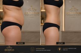 Before and After Liposution in Dubai
