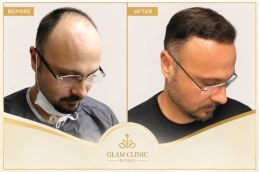 Before and After Results of Hair Transplant in Dubai