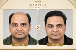 Before and After of FUE in Dubai & Abu Dhabi