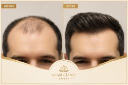 Before and After of Hair Transplant in Dubai 