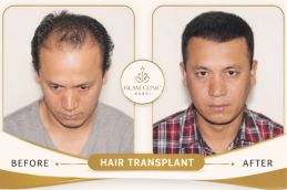 Before and After of Hair Transplant in Dubai