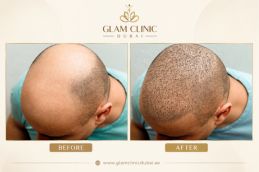 Before and After results of FUE treatment in Dubai