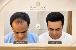 Before and After results of FUE at Glam Clinic