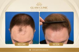 Before and After results of FUE at Glam Clinic Dubai