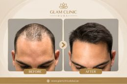 Before and After results of FUE in Dubai & Abu Dhabi  