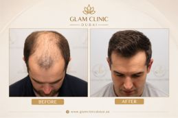 Before and After results of FUE treatment in Dubai & Abu Dhabi