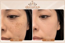 Before and After skin Boster