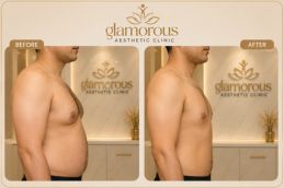 Breast Argmentation in Dubai & Abu Dhabi