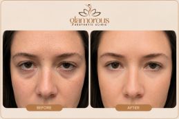 Dermal Fillers by Doctor Maliha