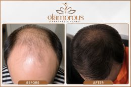 Dhi Hair Transplant before and after