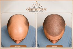 Dhi Hair Transplant result before and after