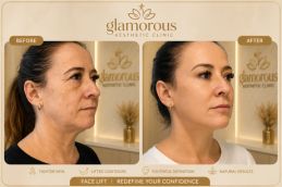 Facelift in Dubai & Abu Dhabi