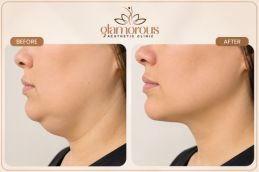Fat Desolving Injections by Doctor Maliha