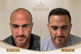 Hair Transplant Before and After results