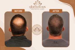 Hair Transplant result in Glamorous clinic Dubai