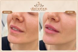 Lip Fillers before and After results