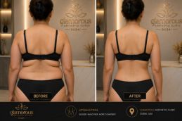 Liposuction Before And After Abu Dhabi