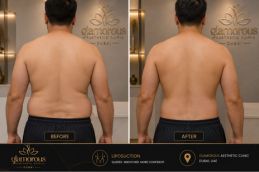 Liposuction Before and After Dubai Abu Dhabi
