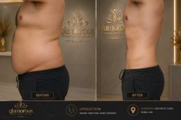 Liposuction before and after treatment in Dubai Abu Dhabi