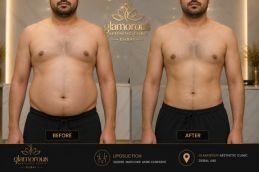 Liposuction in Dubai Before and After