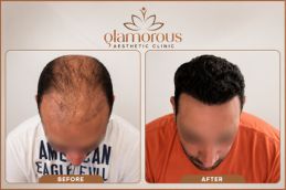 before and after of Dhi Hair Transplant